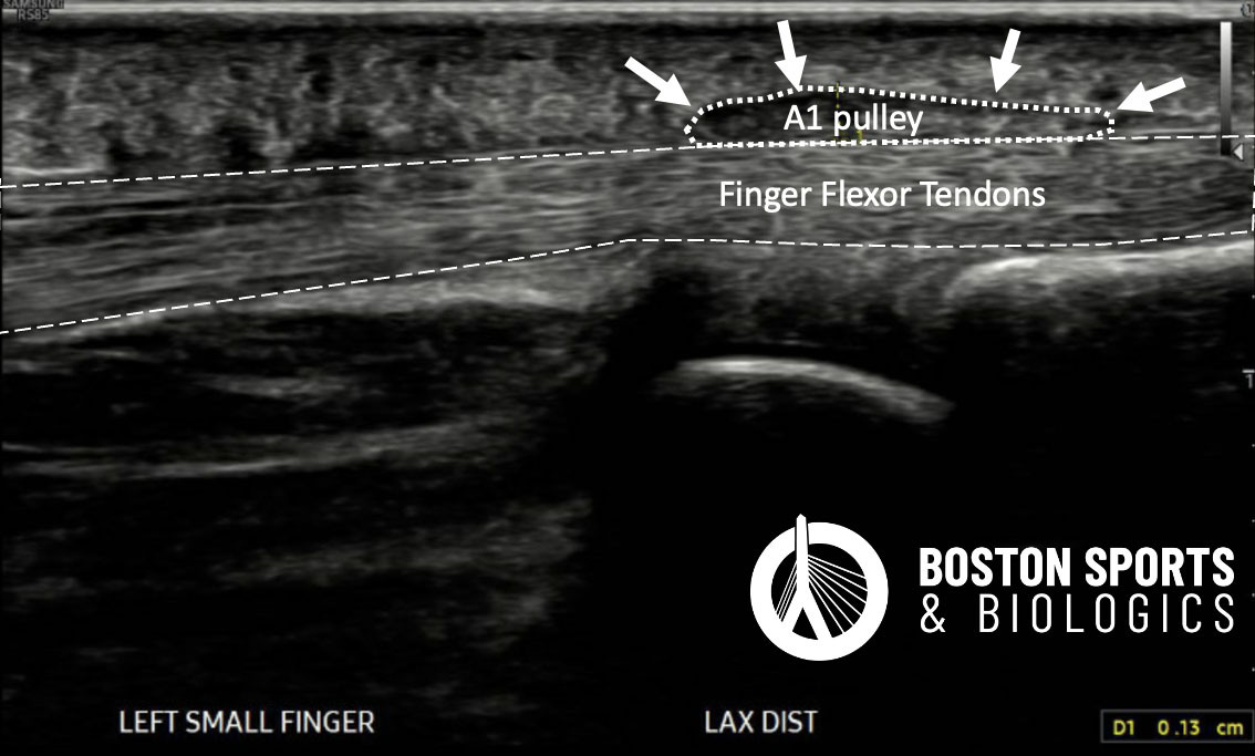 Trigger Finger Ultrasound Images