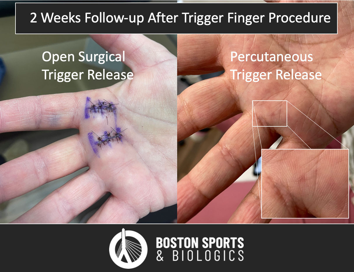 Trigger Finger Swelling After Surgery Infoupdate