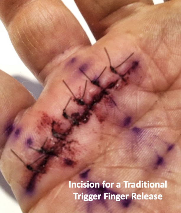 Trigger finger open surgical incision